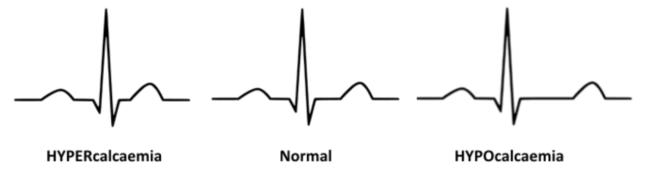 Shortening of QT interval Shortening of QT interval